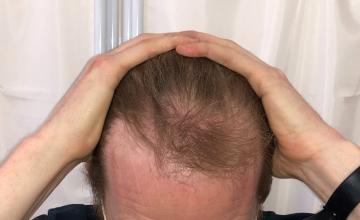 Dr Raghu Reddy, 2800 grafts, Norwood 3A