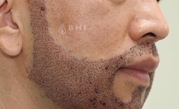 FUE beard hair transplant 2712 grafts Dr. Kongkiat Laorwong, Thailand