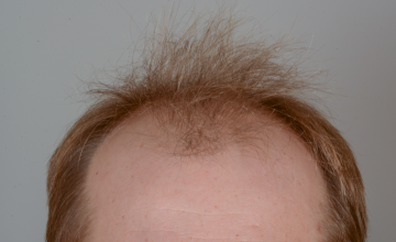 Robert Haber, MD - 2773 grafts FUT, Front - 1 Year