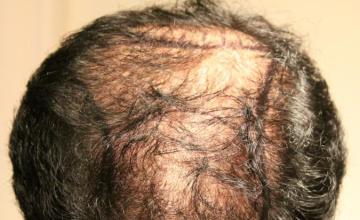 Dr Carman 4241 FU Grafts, 12 month result.