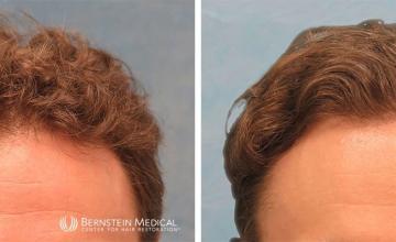 Norwood Class 3V 1,760 and 1,428 Grafts FUE-R - Dr. David Bernstein
