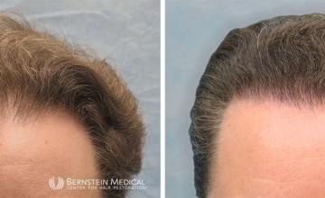Norwood Class 3A 1,465 Grafts FUE-R - Dr. David Bernstein