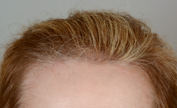 Robert Haber, MD - 1794  grafts FUT Female Hairline - 6 months
