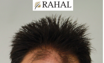 Dr.Rahal /3,088 grafts / FUT