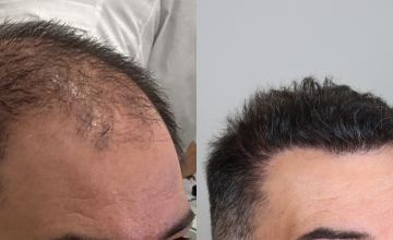 Dr. Espinosa Custodio - 3545 grafts