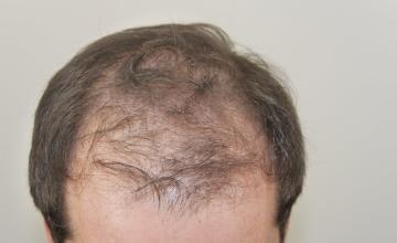 Dr. Glenn Charles 2555 grafts FUT