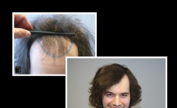 PANINE, MD | Chicago Hair Transplant Clinic - FUT Hair Transplant Patient Results with 3,050 Grafts