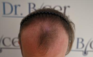 Ozlem Bicer MD-Hair Transplant-4010 Grafts FUE by micro-motor, 10. months result