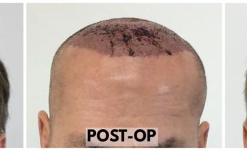 FUE Hair Transplant - 2661 Grafts in 1 Session - Dr. Rahal