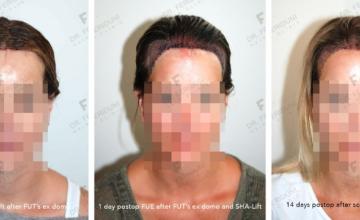 Repair case performed by Dr. Feriduni – SHA-Lift, scar correction and FUE in 2 procedures