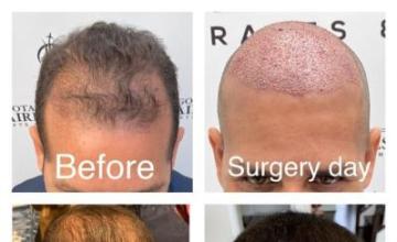 12 months results / Bogota Hairlines 2978 grafts