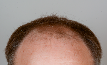 Robert Haber, MD - 2508 grafts FUT, Front and midscalp - 1 Year