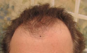 Dr Carman 3583 FU Grafts, 14 month result.