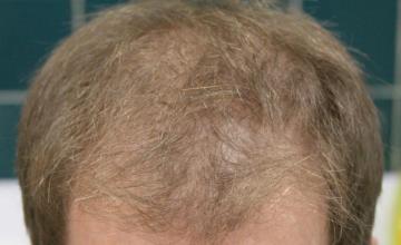 Dr Carman 2402 FU Grafts 1 Year Result