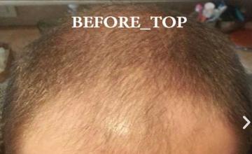 3150 FUE grafts by Dr. Maras at HDC clinic in Cyprus