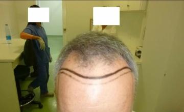 Dr. Maras at HDC clinic in Cyprus, 3465 FUE grafts, 43 years old patient
