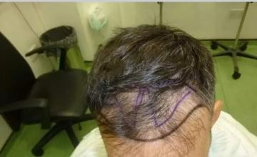 Dr. Maras at HDC clinic in Cyprus, post 8 years result for 2066 FUE grafts