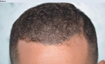 3000 FUE grafts by Dr. Maras at HDC clinic, paitent had SMP before his procedure