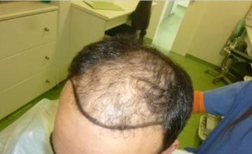 Dr. Maras  at HDC clinic in Cyprus, NW6 with 4954 FUE grafts post 2 procedures result