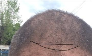 Repair FUE procedure by Dr. Maras at HDC clinic over hair mill result from Turkey