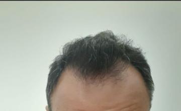 3010 FUE grafts by Dr. Maras at HDC clinic, frontal + crown, post 12 months result