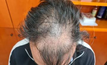 3567 FUE grafts for NW4 by Dr. Maras at HDC clinic