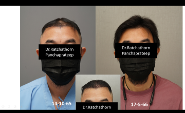 Dr.Ratchathorn Panchaprateep, MD, PhD (Absolute hair clinic): Norwood 4 with diffuse thinning of midscalp, 7 months after 3,518 grafts FUE