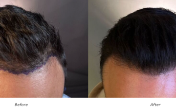 Dr. Arocha | 1500 Graft FUE | 8-month Results