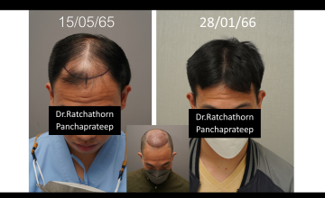 Dr.Ratchathorn Panchaprateep, MD, PhD (Absolute hair clinic): Norwood 5, 8 months after 3620 grafts FUE (life changing look)