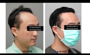 Dr.Ratchathorn Panchaprateep (Absolute hair clinic) Norwood IV anterior: 6.5 months after 2810 grafts FUE