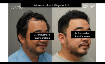 Dr.Ratchathorn Panchaprateep (Absolute hair clinic, Bangkok), Asian male with NW IV at 6 months after 2850 grafts FUE