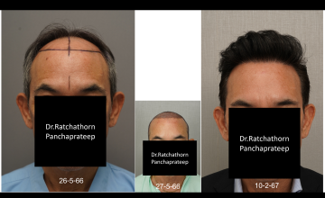 Dr.Ratchathorn Panchaprateep (Absolute hair clinic, Bangkok), Asian male with NW IV-V at 11 months after 3504 grafts FUE