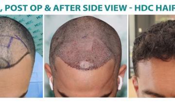 FUE Procedure Outcome: 2400 Grafts at HDC Hair Clinic