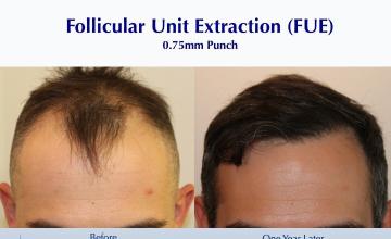 Hairline for the Holidays (2347 FUE scalp and beard): Carlos K. Wesley, M.D. (NYC & LA)
