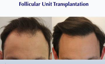 Healthy New Year.  Healthy New Hairline (2455 FUT grafts): Carlos K. Wesley, M.D. (NYC & LA)