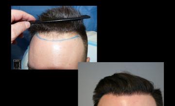 PANINE, MD | Chicago Hair Transplant Clinic | FUE Hair Transplant Results with 2,500 Grafts