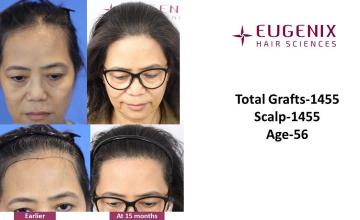 Dr. Pradeep Sethi| Eugenix Hair Sciences Clinic| 1455 Grafts | 15 Months Post-op| Female Hair Transplant