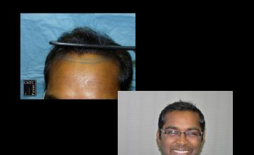 PANINE, MD | Chicago Hair Transplant Clinic | FUT Hair Transplant with 2,500 Grafts at 7 Months Post-Op