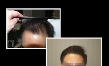 PANINE, MD | Chicago Hair Transplant Clinic - FUT Hair Transplant Results w/ 3,257 Grafts