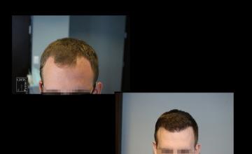 PANINE, MD | Chicago Hair Transplant Clinic - 3,046 Graft FUT Hair Transplant Results After Only 7 Months