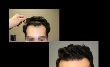 PANINE, MD | Chicago Hair Transplant Clinic - 2,300 Graft FUE Hair Transplant Results After 1 Year