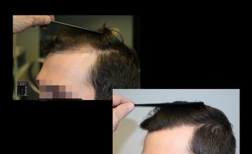 PANINE, MD | Chicago Hair Transplant Clinic | 2,000 Graft FUE Hair Transplant Results at 13 Months Post-Op
