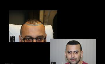 PANINE, MD | Chicago Hair Transplant Clinic - FUE Hair Transplant with 2,579 Grafts @ 2 weeks, 4/6 Months