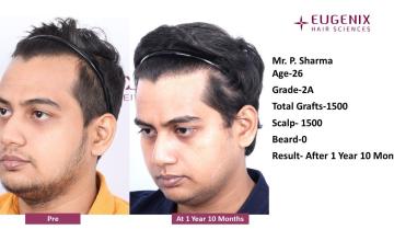 Dr. Arika Bansal| Eugenix Hair Sciences Clinic | NW 2A | 1500 Grafts | 22 Months Post-op