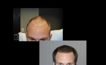 PANINE, MD & Chicago Hair Transplant Clinic - FUE Hair Transplant | 6 Months Post-Op with 2,912 Grafts