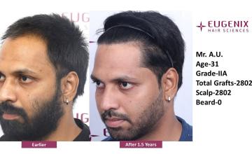 Dr. Priyadarshini Das | Eugenix Hair Transplant Clinic | NW 2A | 2802 Grafts | 18 Months Post-op