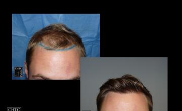 PANINE, MD | Chicago Hair Transplant Clinic - Hair Restoration - FUT with 2,981 Grafts