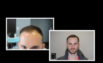 PANINE, MD - Chicago Hair Transplant Clinic - FUE Hair Transplant Results