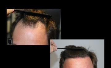 PANINE, MD | Chicago Hair Transplant Clinic | FUE Hair Transplant Patient’s Results w/ 2,500 Grafts, One Year Post-Op