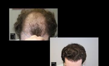 PANINE, MD | Chicago Hair Transplant Clinic | 2 FUE Surgeries with 5,163 Grafts